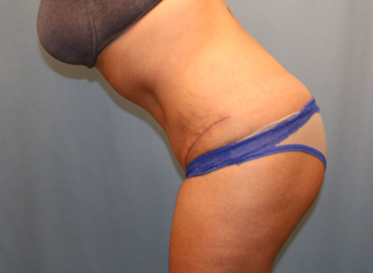 After Image: Tummy Tuck - other
