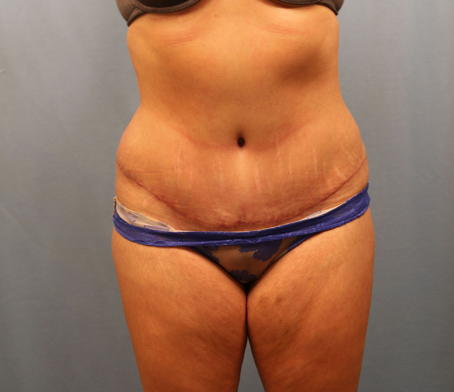 After Image: Tummy Tuck - front