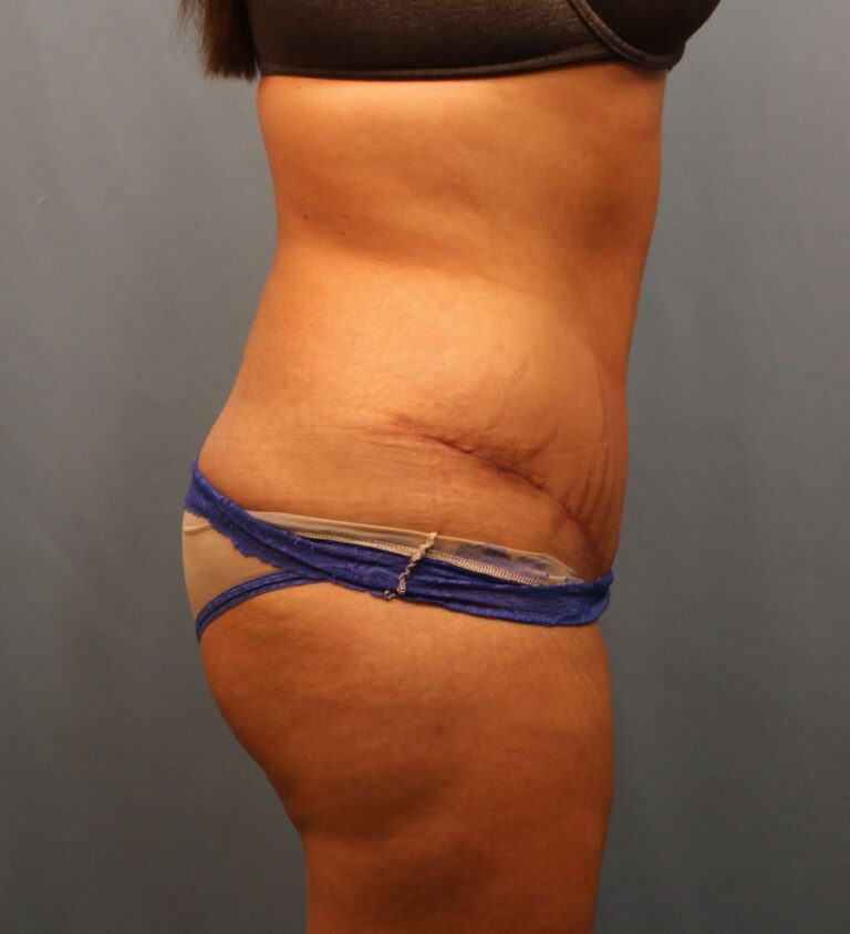 After Image: Tummy Tuck - right-side