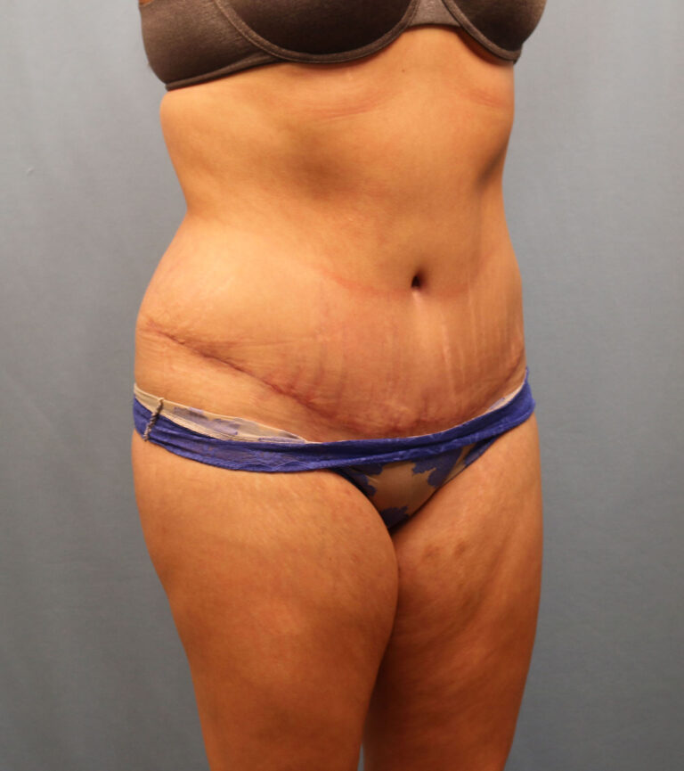 After Image: Tummy Tuck - right-front-oblique