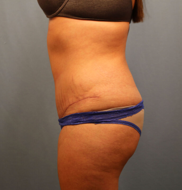 After Image: Tummy Tuck - left-side