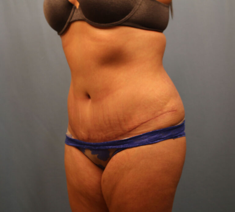 After Image: Tummy Tuck - left-front-oblique