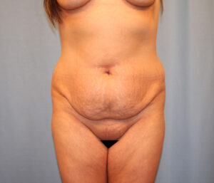 Before Image: Tummy Tuck