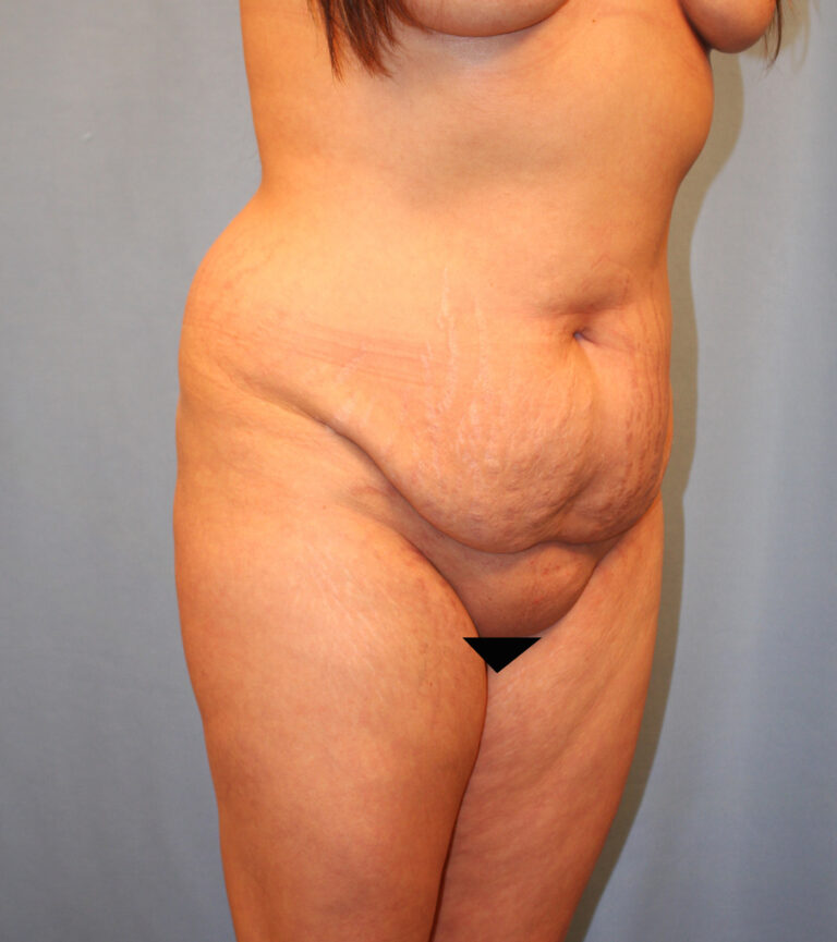 Before Image: Tummy Tuck - right-front-oblique