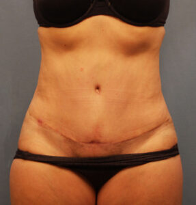 After Image: Tummy Tuck