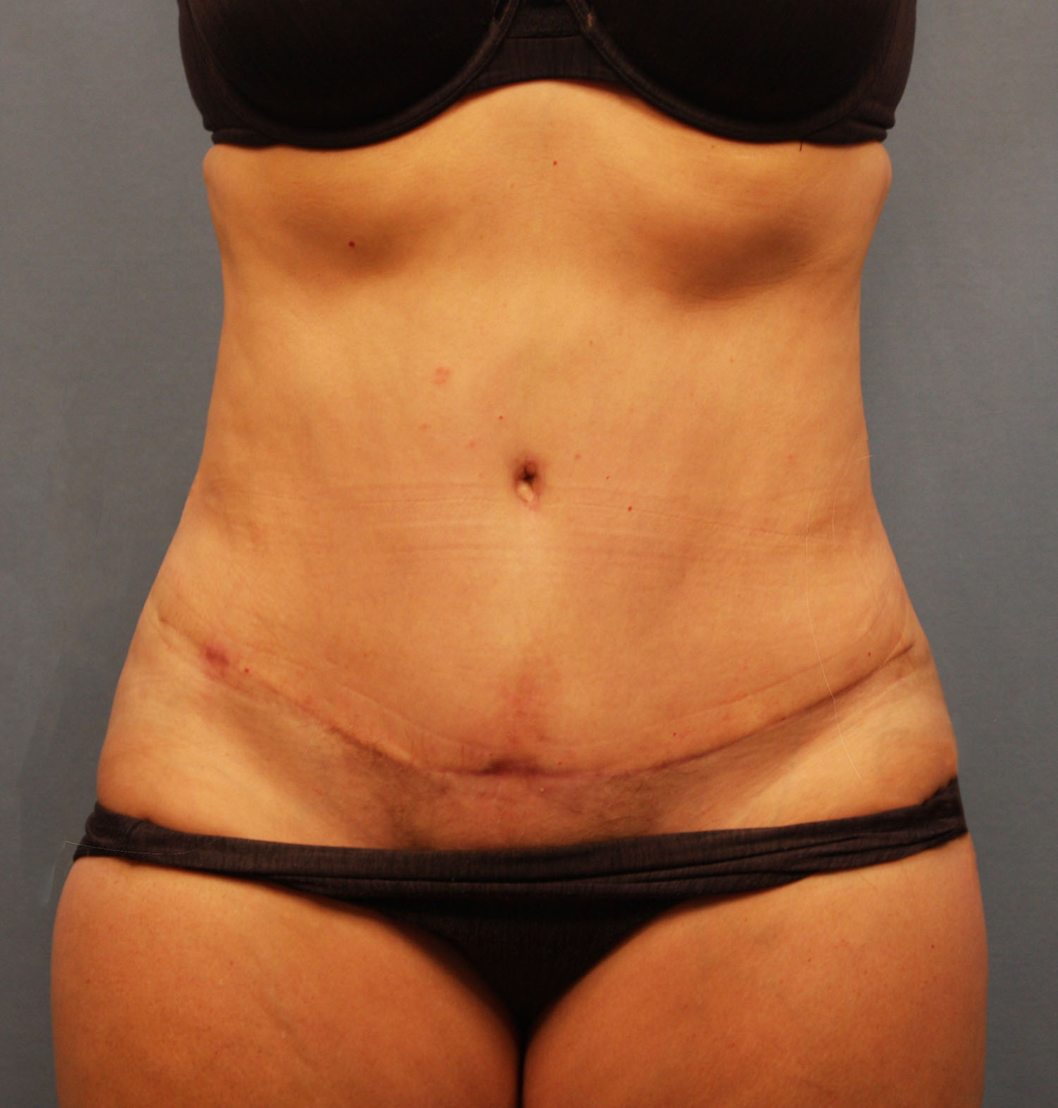 After Image: Tummy Tuck - front
