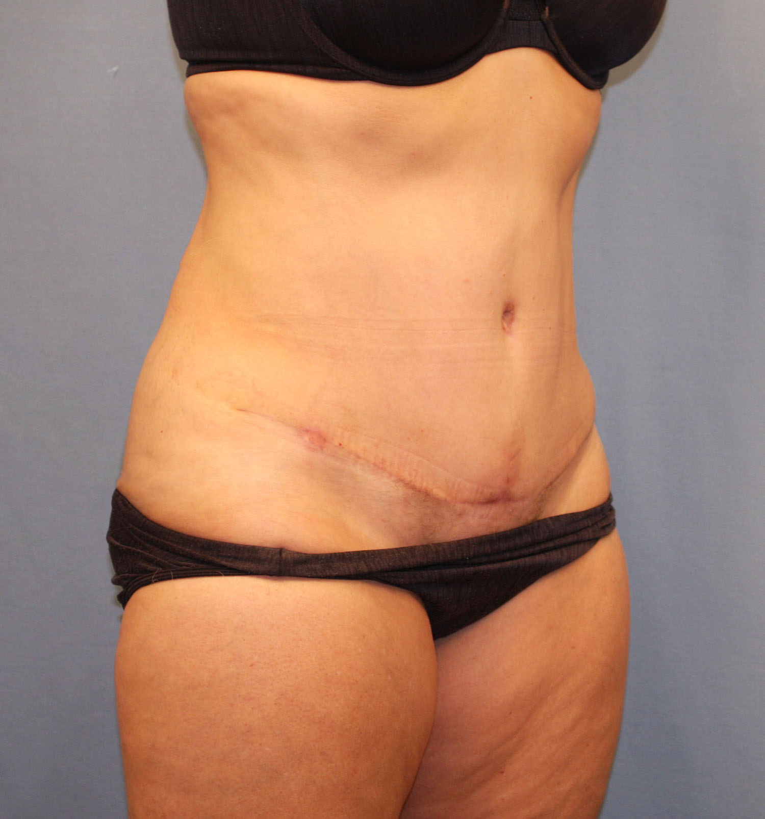 After Image: Tummy Tuck - right-front-oblique