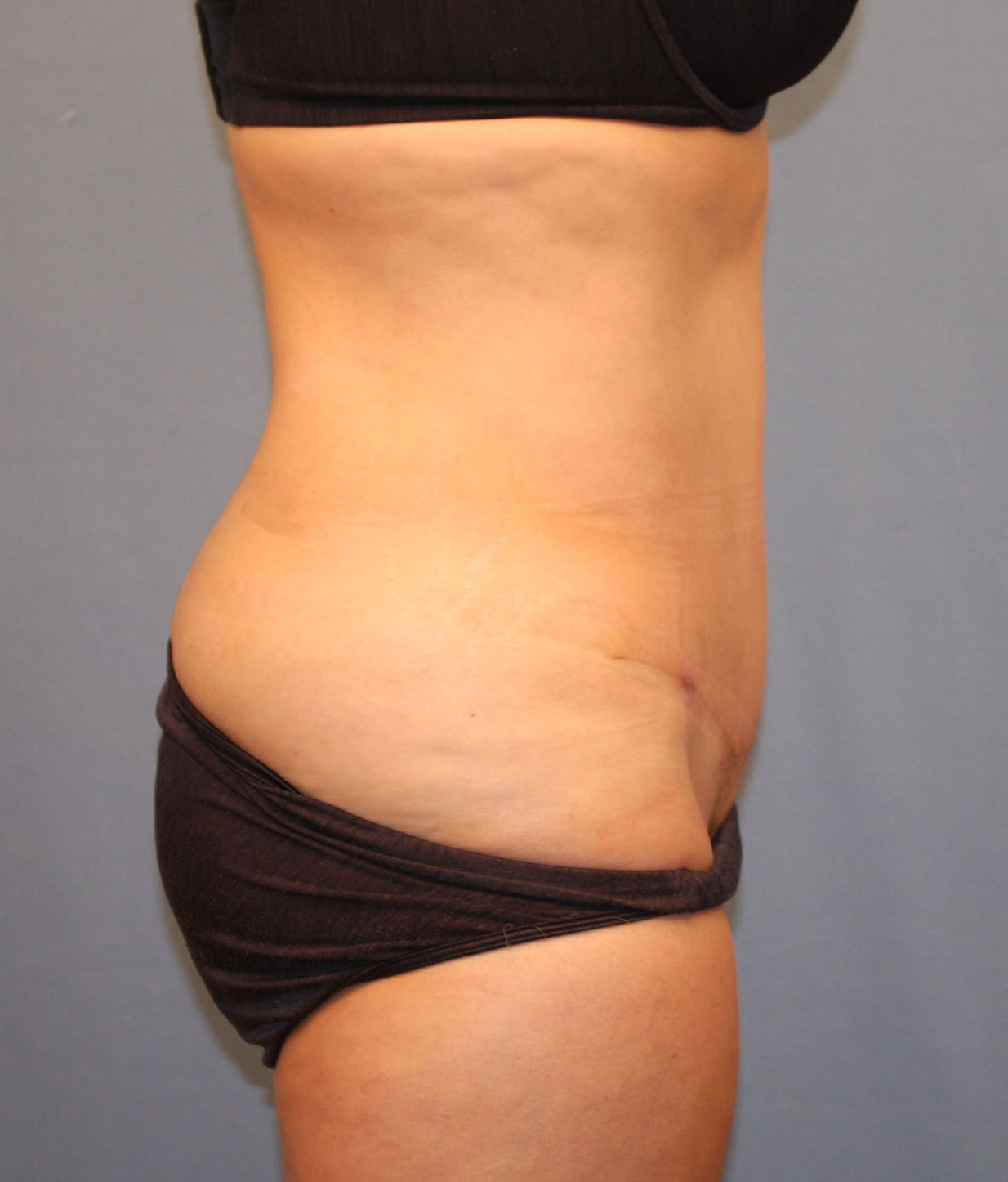 After Image: Tummy Tuck - right-side