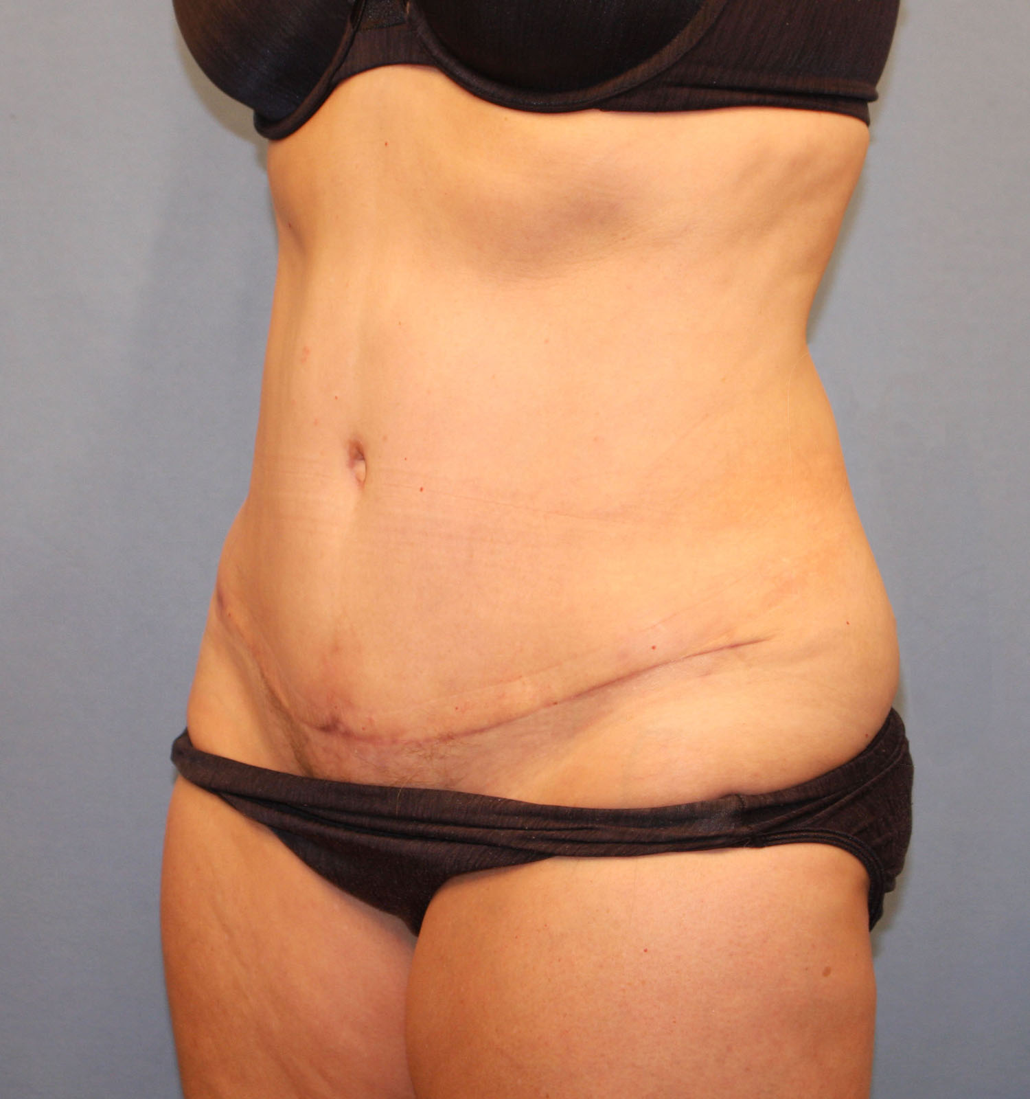 After Image: Tummy Tuck - left-front-oblique