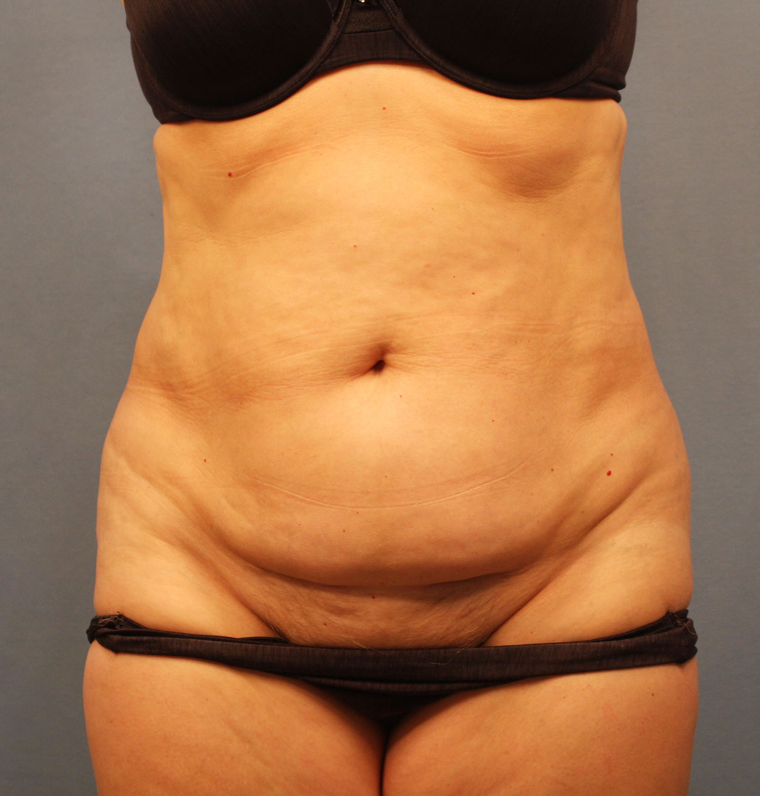 Before Image: Tummy Tuck - front
