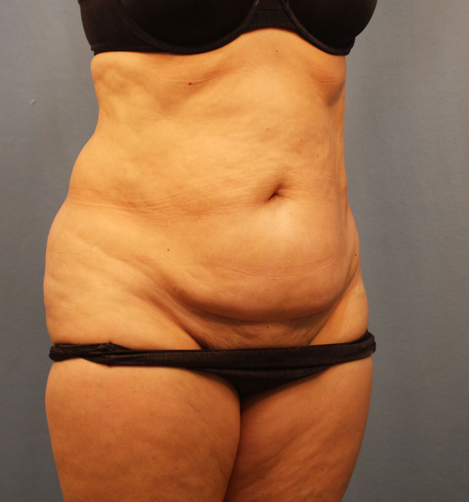 Before Image: Tummy Tuck - right-front-oblique