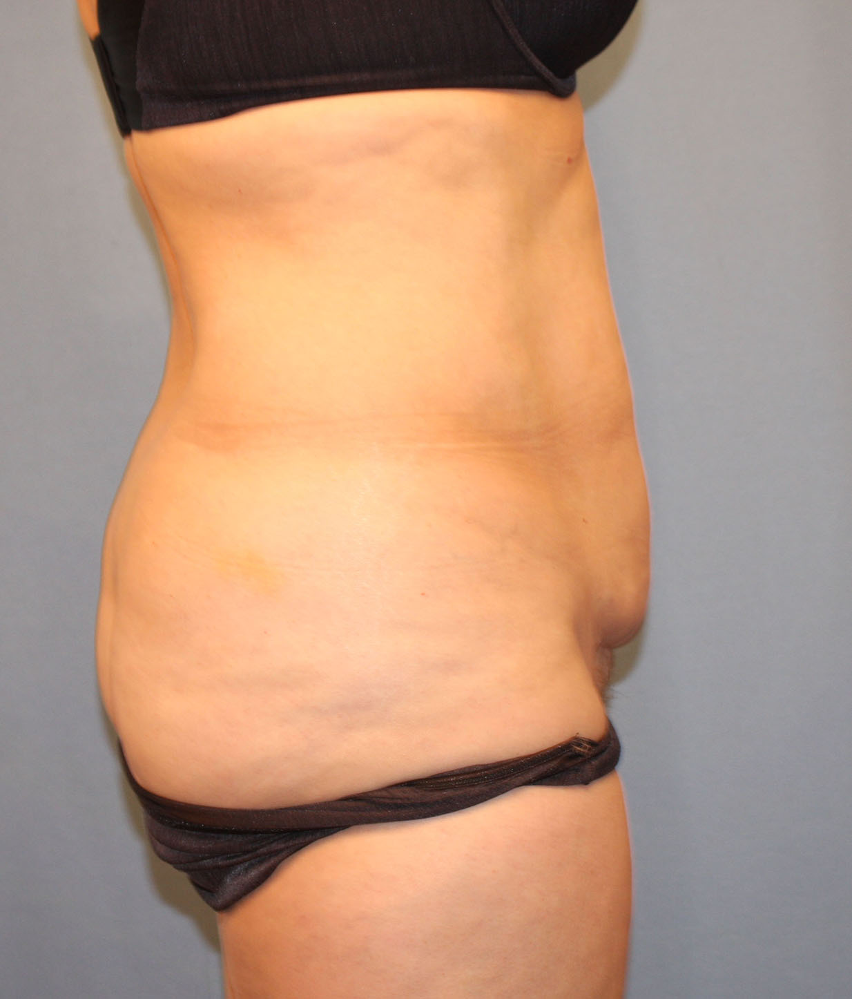 Before Image: Tummy Tuck - right-side