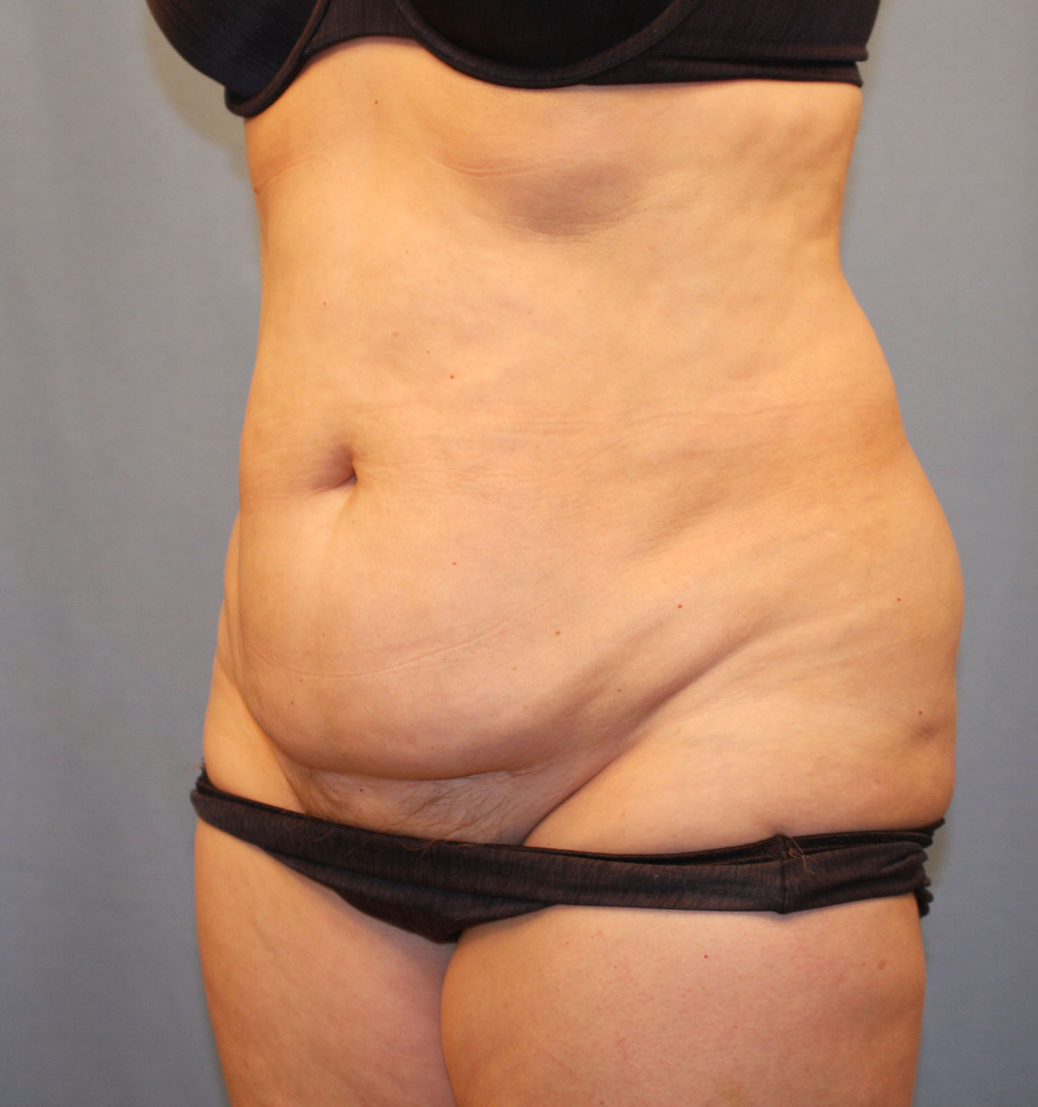 Before Image: Tummy Tuck - left-front-oblique