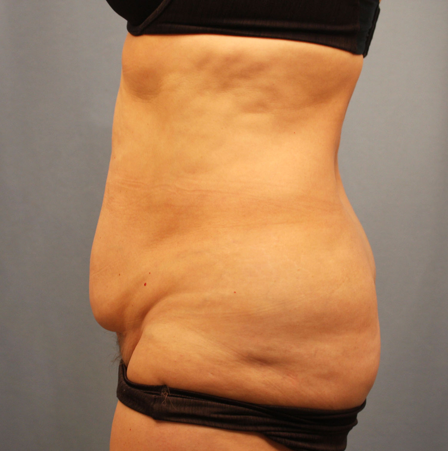 Before Image: Tummy Tuck - left-side