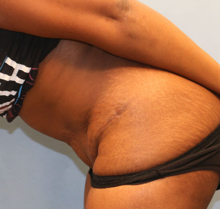 After Image: Tummy Tuck - other