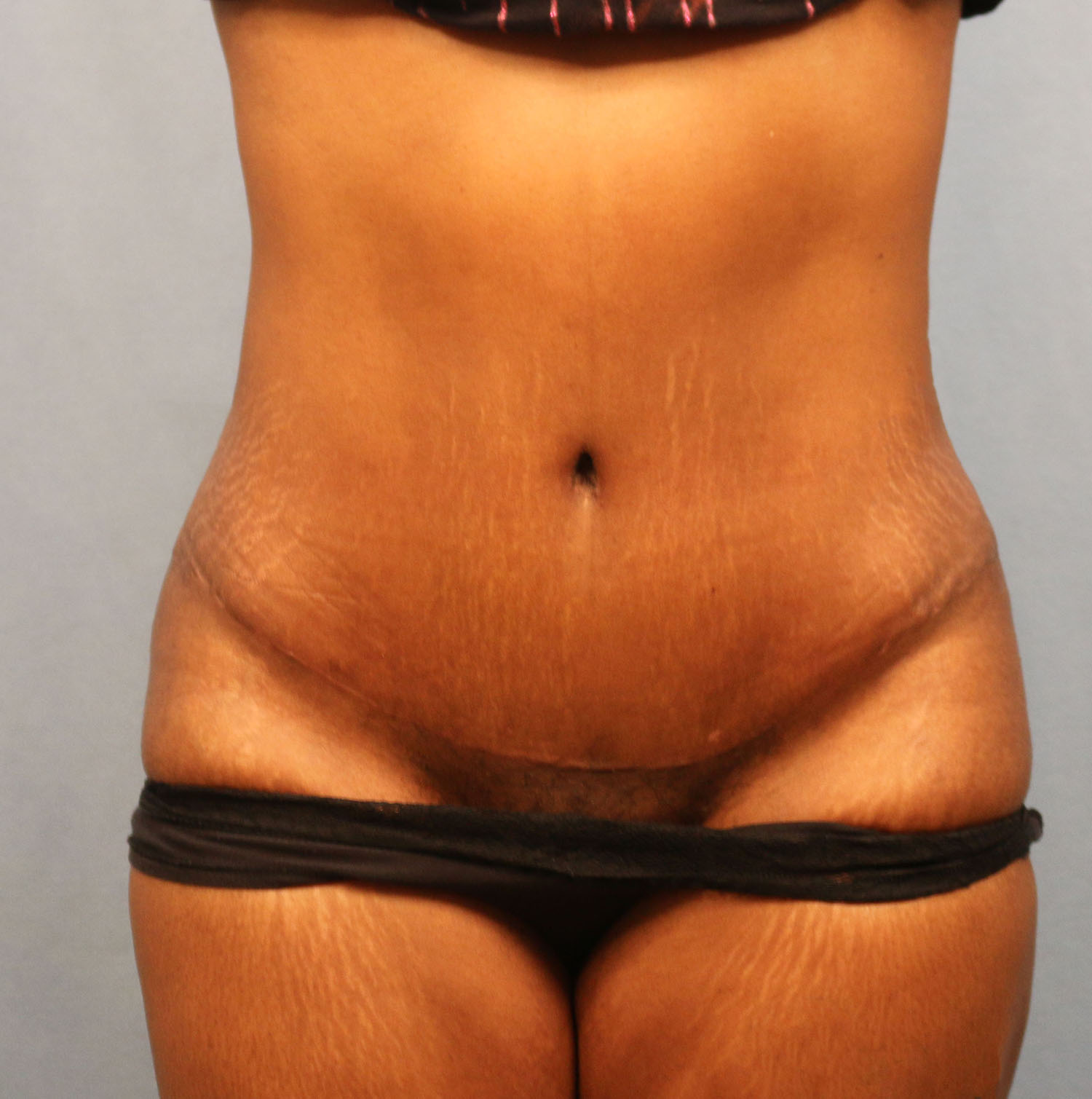 After Image: Tummy Tuck - front