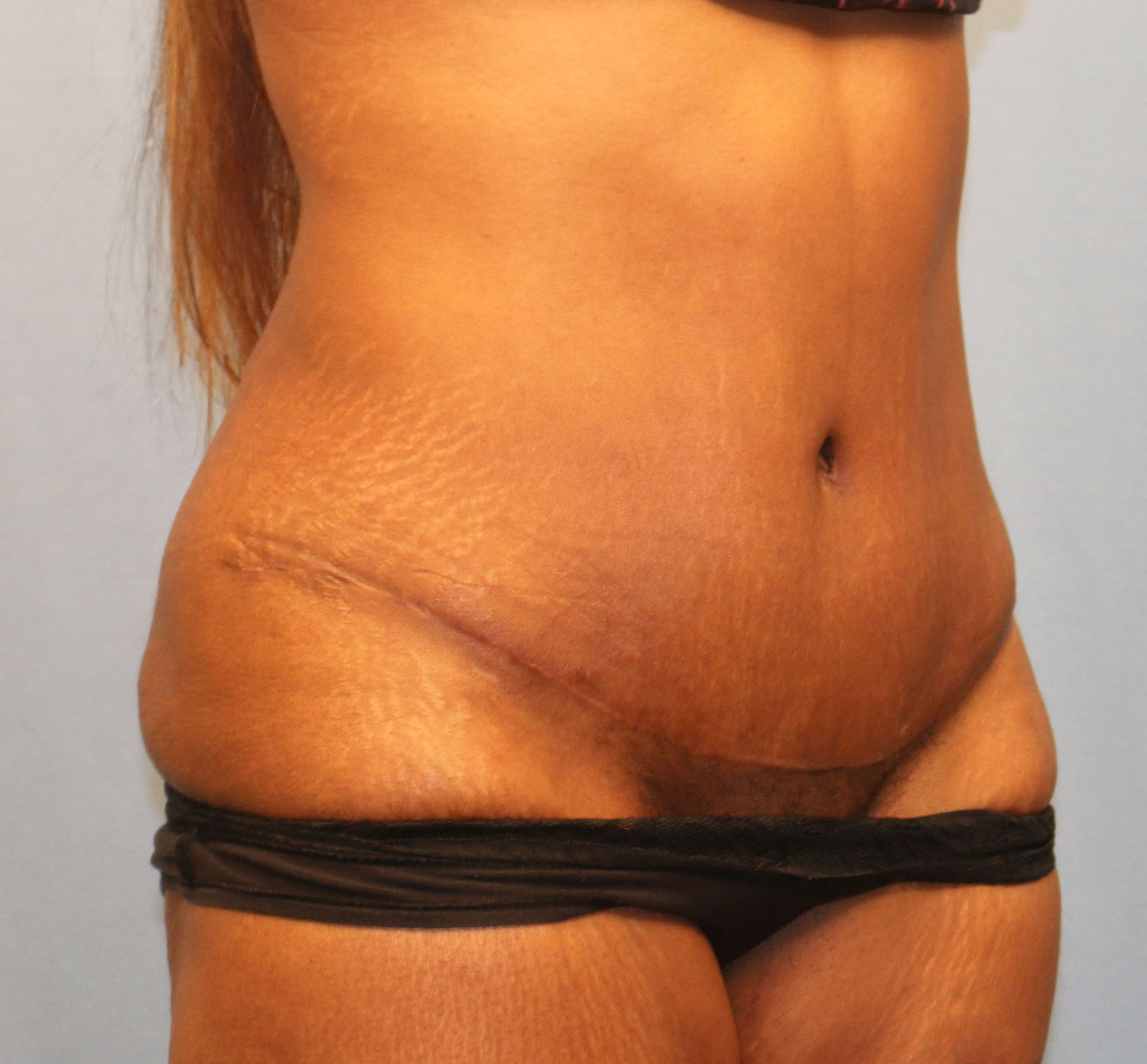 After Image: Tummy Tuck - right-front-oblique