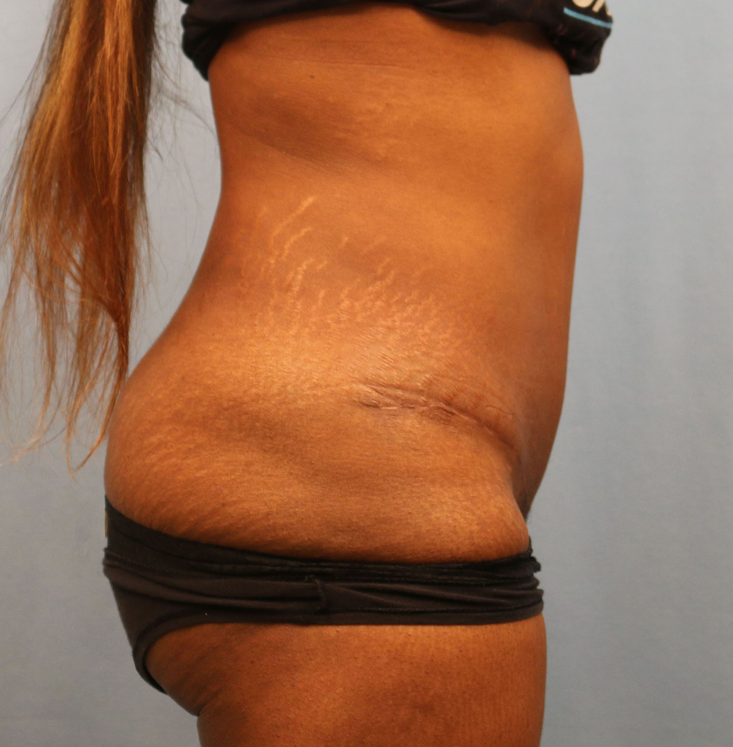 After Image: Tummy Tuck - right-side