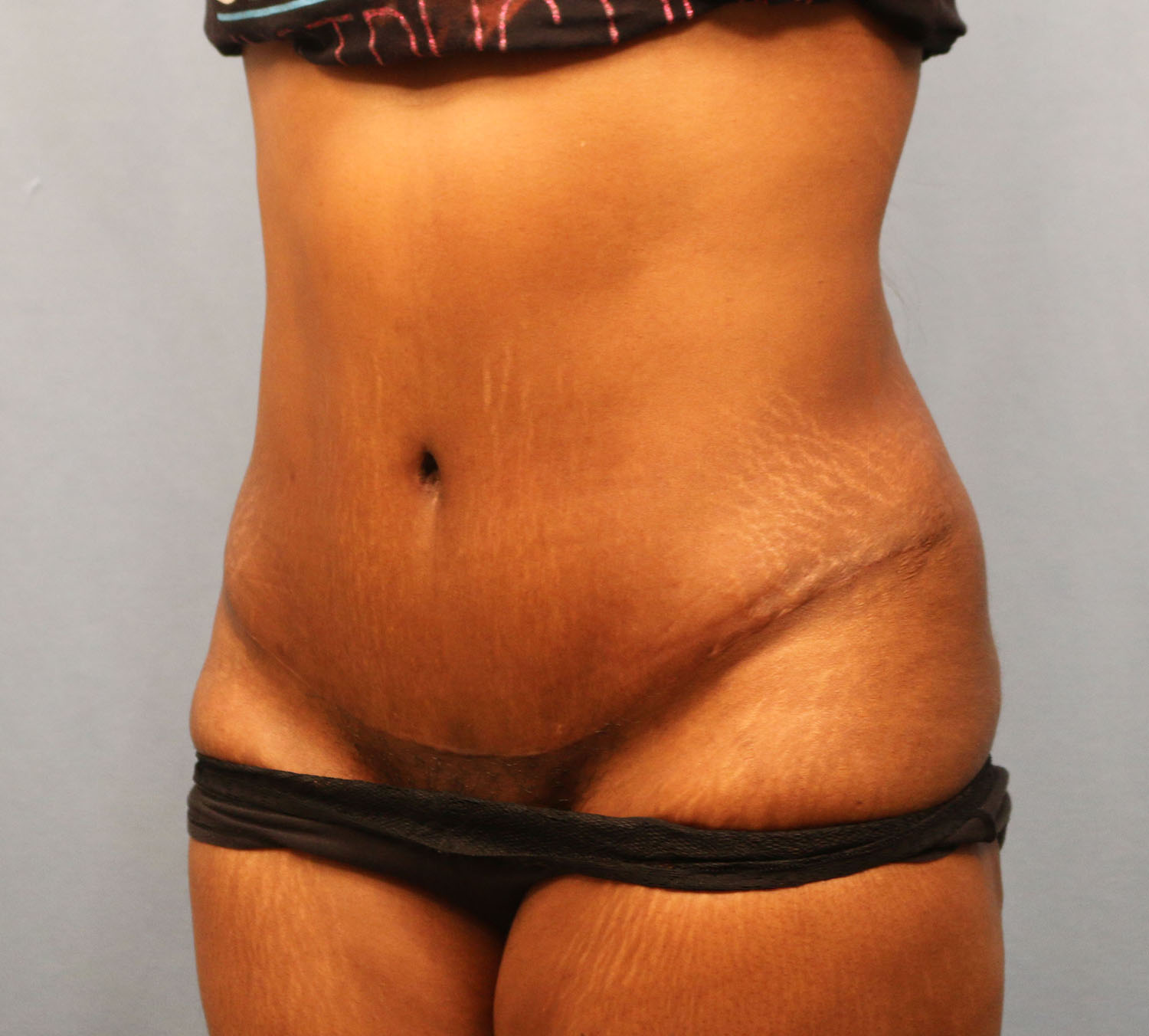 After Image: Tummy Tuck - left-front-oblique