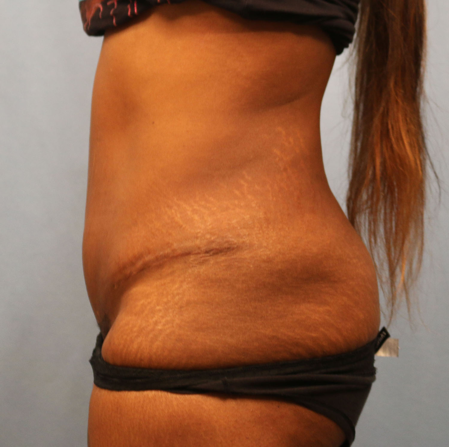 After Image: Tummy Tuck - left-side