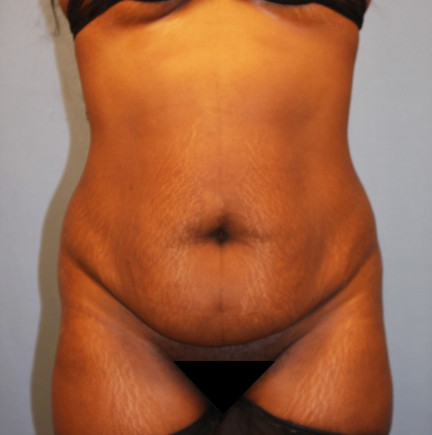 Before Image: Tummy Tuck - front