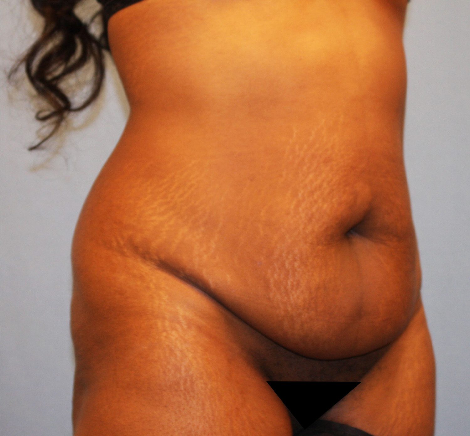 Before Image: Tummy Tuck - right-front-oblique