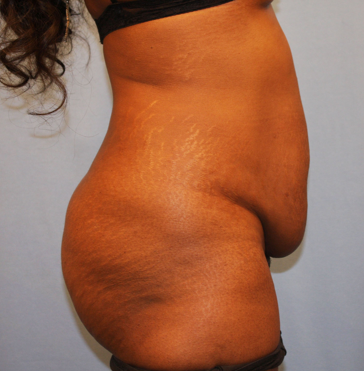 Before Image: Tummy Tuck - right-side