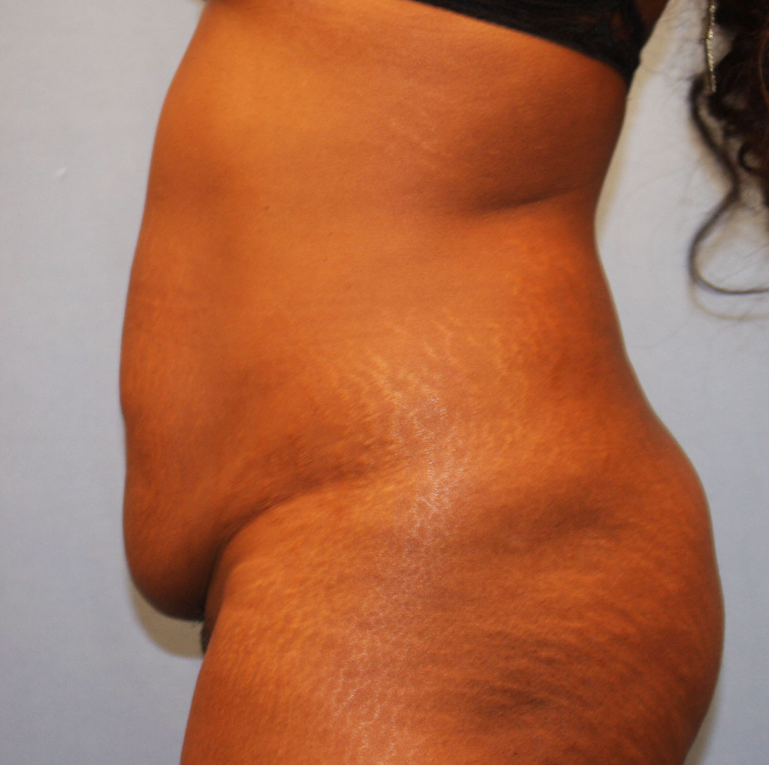 Before Image: Tummy Tuck - left-side