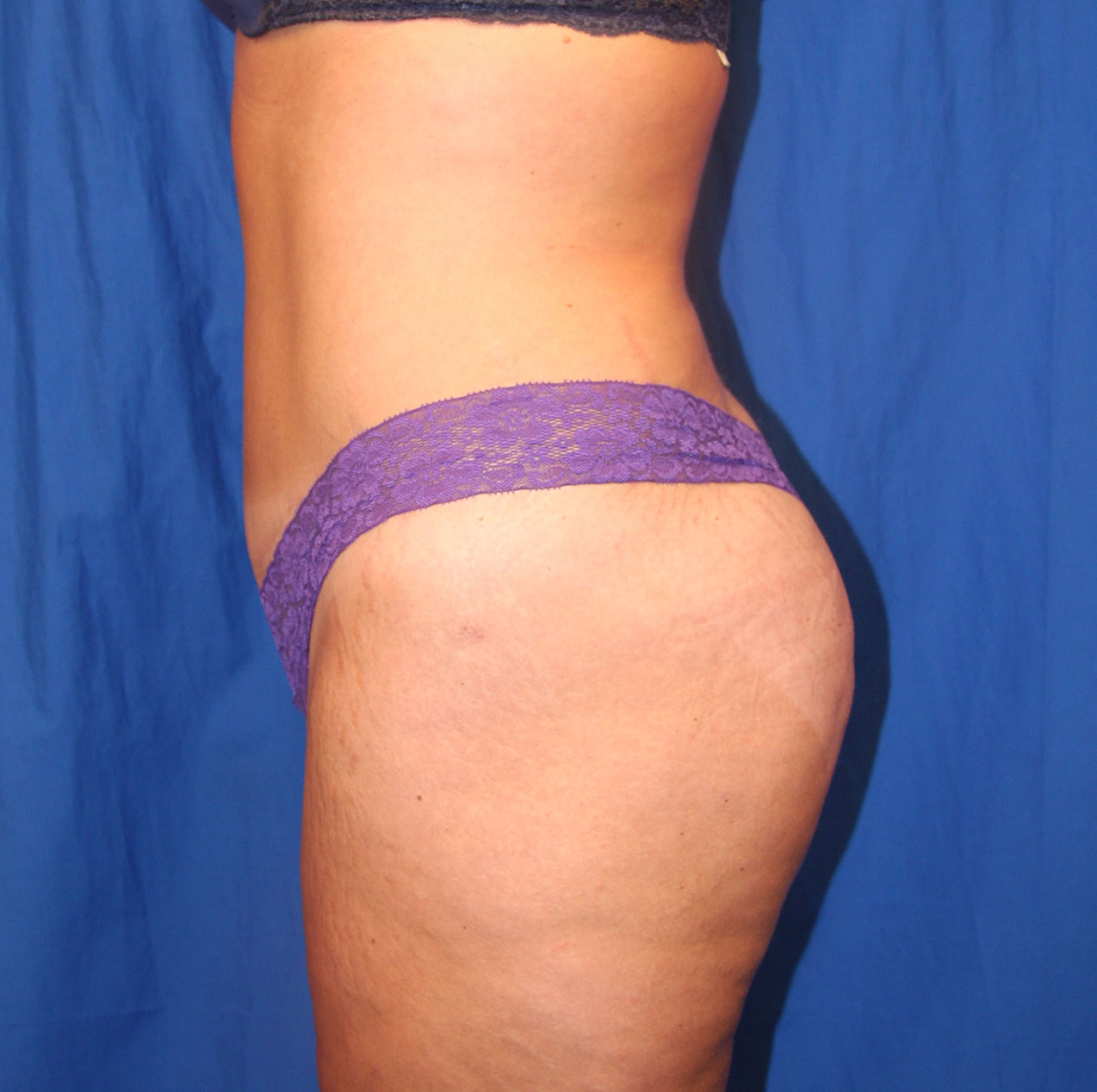 After Image: Tummy Tuck - left-side