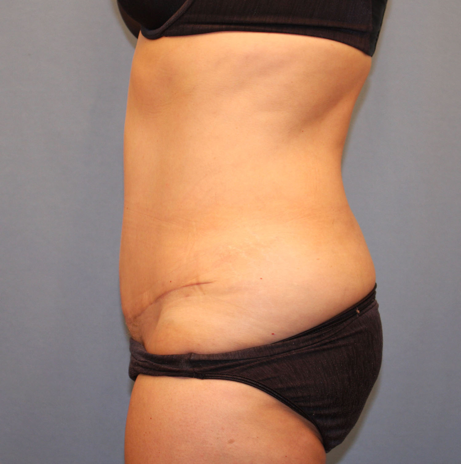 After Image: Tummy Tuck - left-side