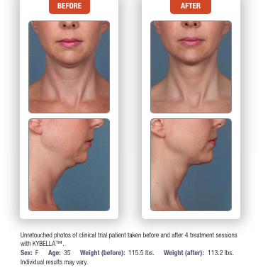 before after Kybella Little Rock AR