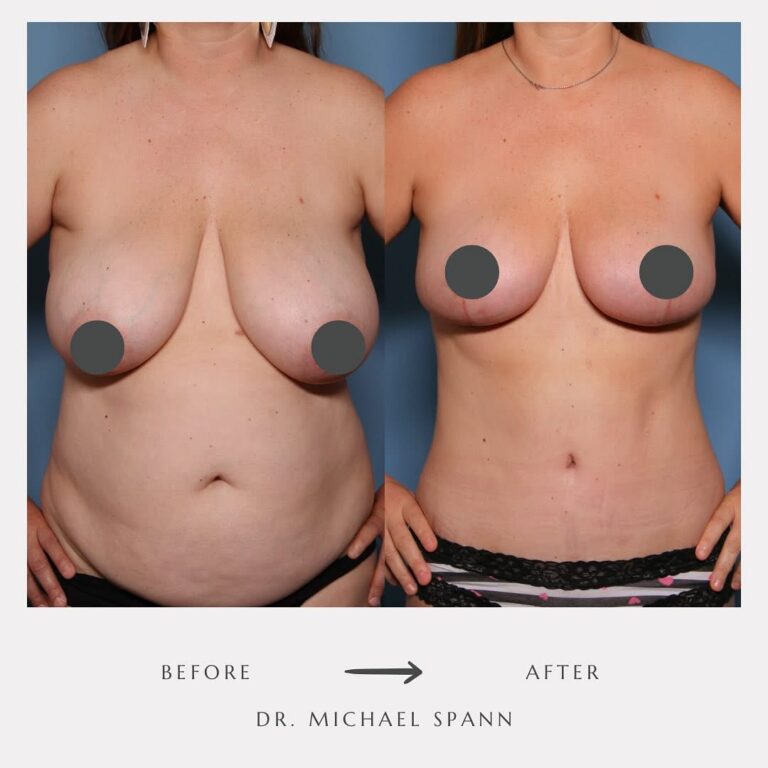 body-contouring-after-ozempic-before-after.jpg body-contouring-after-ozempic-before-after.jpg