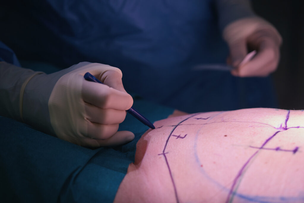 Surgeon marking cutting lines on a patient’s abdomen in preparation for a tummy tuck procedure, outlining areas for skin removal and body contouring.