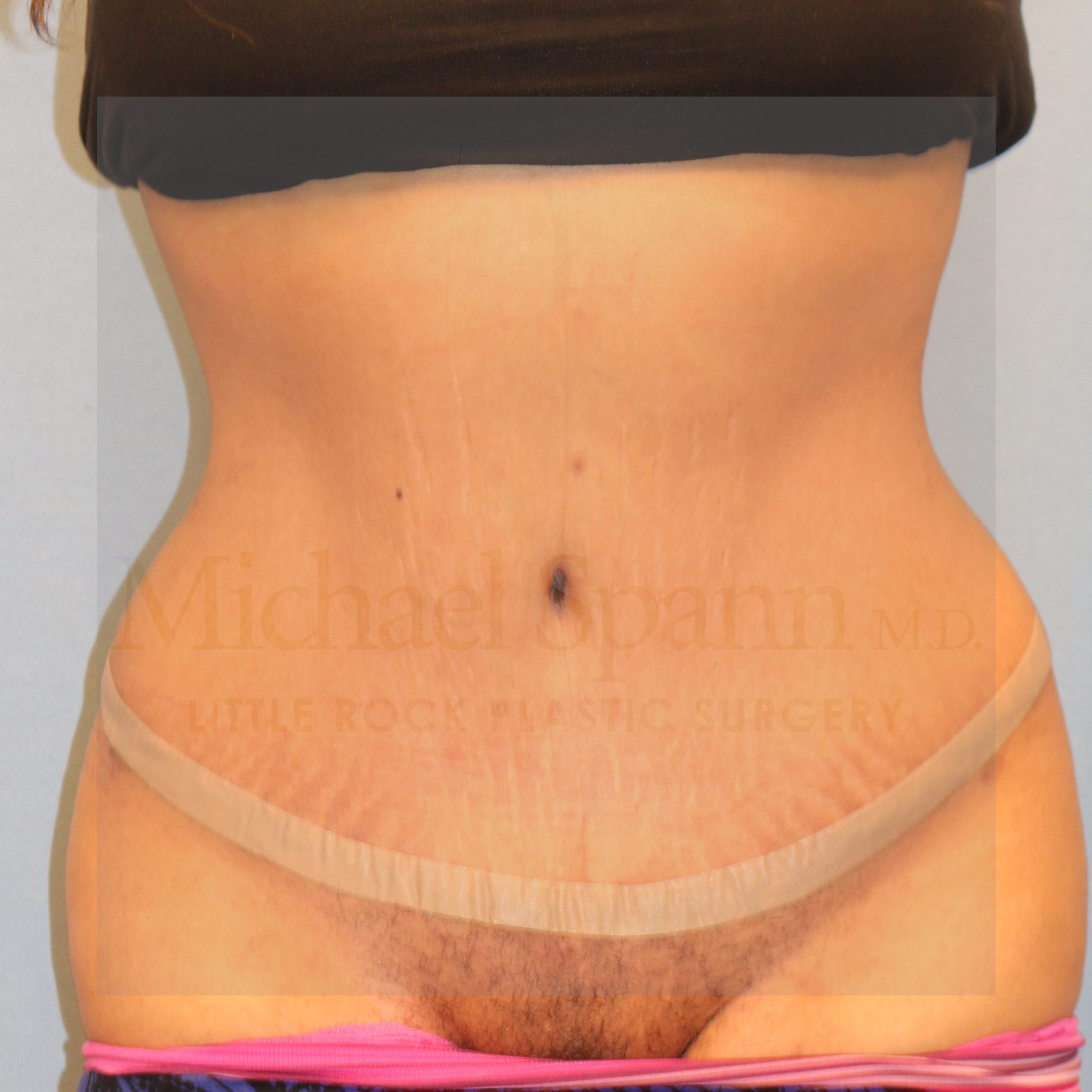 After Image of Tummy Tuck Little Rock AR