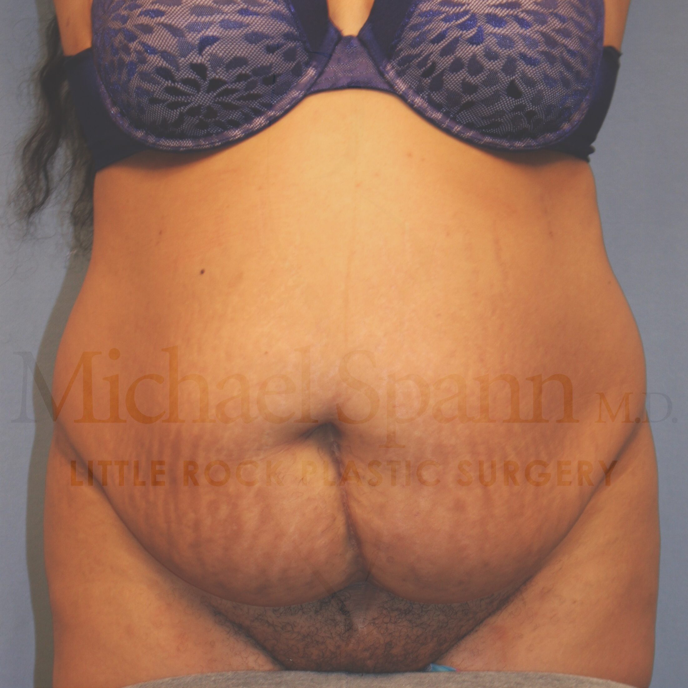 before image of Tummy Tuck Little Rock AR